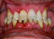 Gingivitis treatment