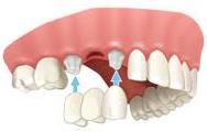 Dental implant