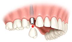 Dental implant