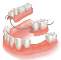 Dental implants