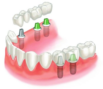 Placement of implant