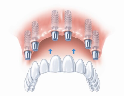 Placement of implant