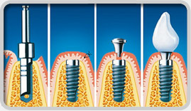 Dental implants