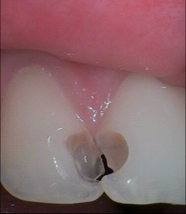 Зуб перед восстановлением