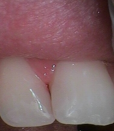 Зуб после восстановления