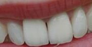 Ceramic veneer