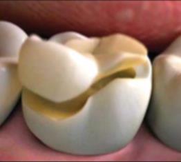Онлей керамические вкладки в зуб