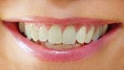 Teeth whitening – before