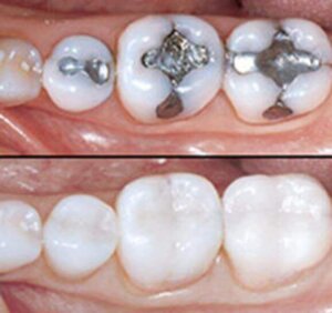 All-ceramic crowns