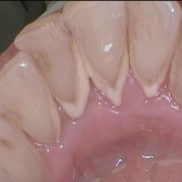 Удаление зубного налета