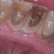Dental calculus and pigmentation
