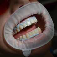WhiteSmile Light Whitening AC teeth whitening