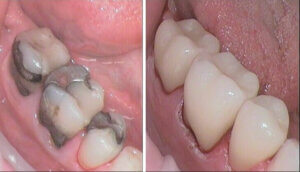 Dental crowns