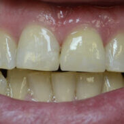 Discoloured teeth