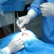 Wisdom tooth extraction