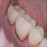 Uus hammas vähem kui 24 tunniga