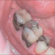 Имплантация зубов за 1 день‎